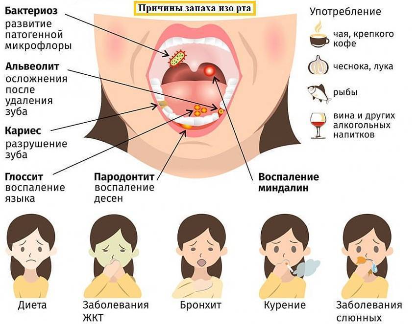 Запах ацетона изо рта у ребенка: 6 причин, 1 лечение