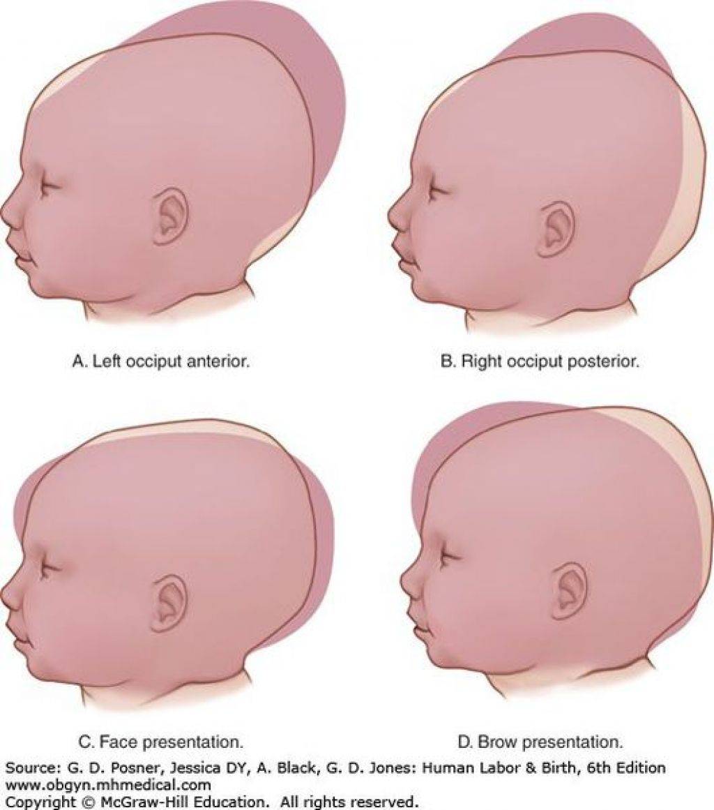 Гематома на голове у новорожденного после родов: последствия и лечение
