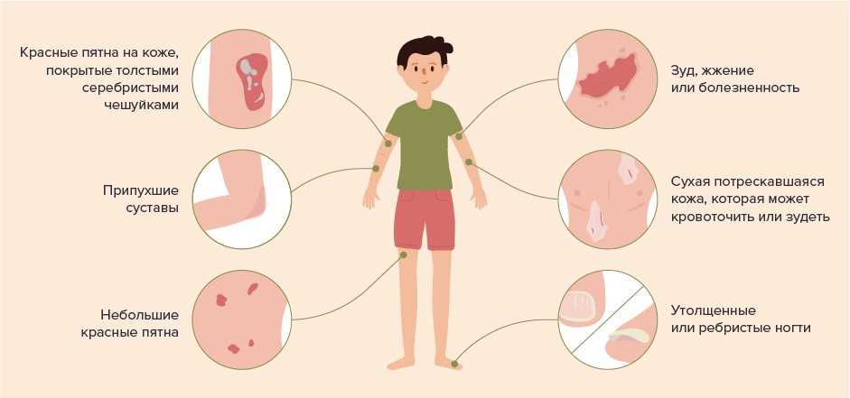 Псориаз у детей: факторы развития недуга, 6 видов болезни, 3 стадии, симптомы, методы лечения