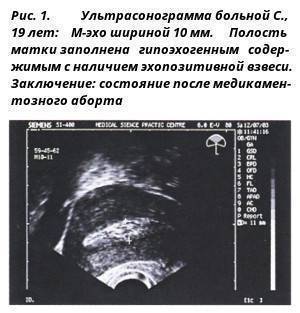Неполный аборт