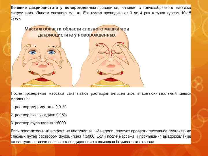 Дакриоцистит новорожденных