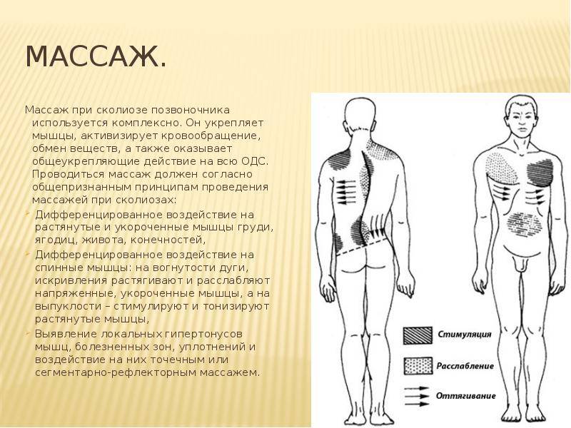 Массаж при сколиозе 1 и 2 степени у детей