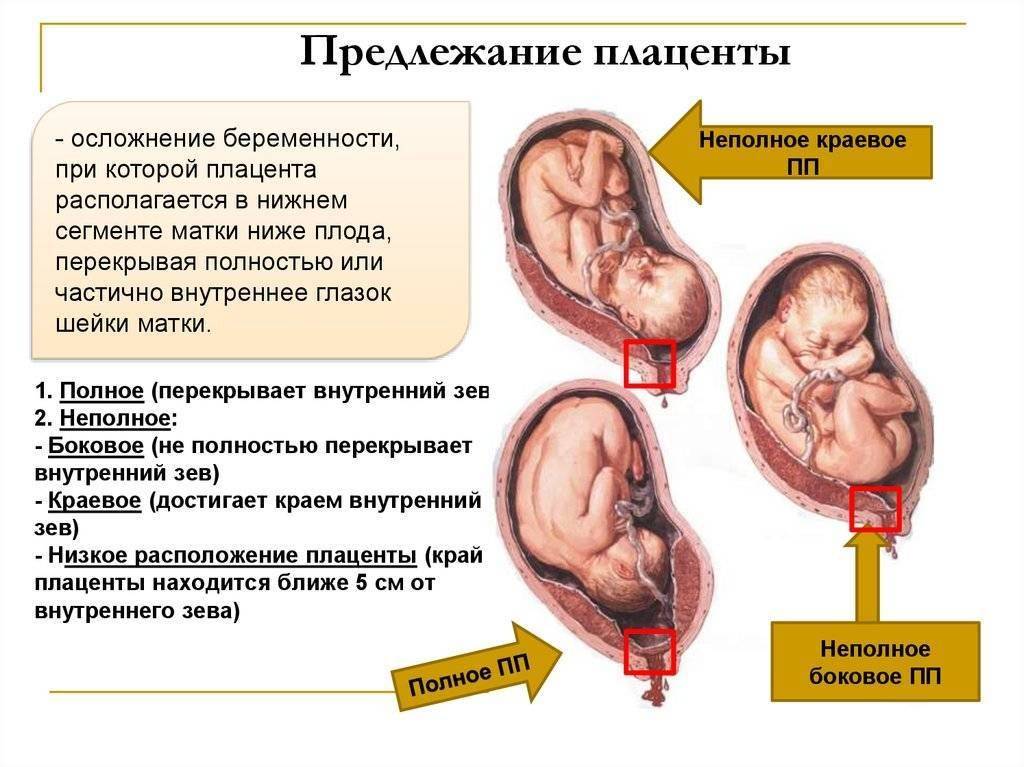 Низкая плацентация при беременности | уроки для мам