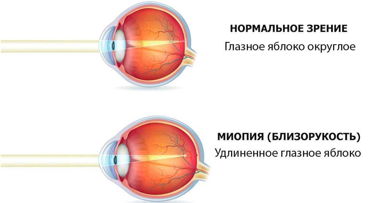 Близорукость у детей школьного возраста. причины, симптомы.
