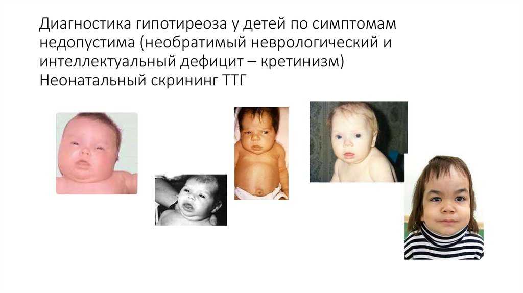 Гипотиреоз у ребенка