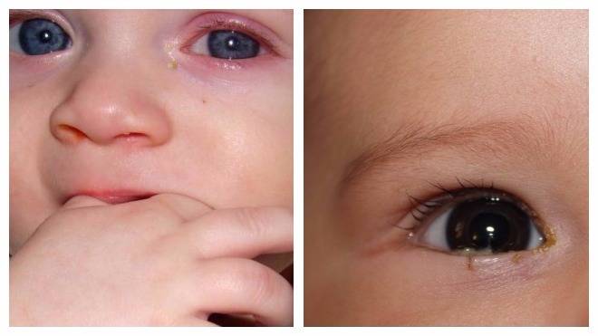 Чем лучше промывать глазки новорожденного