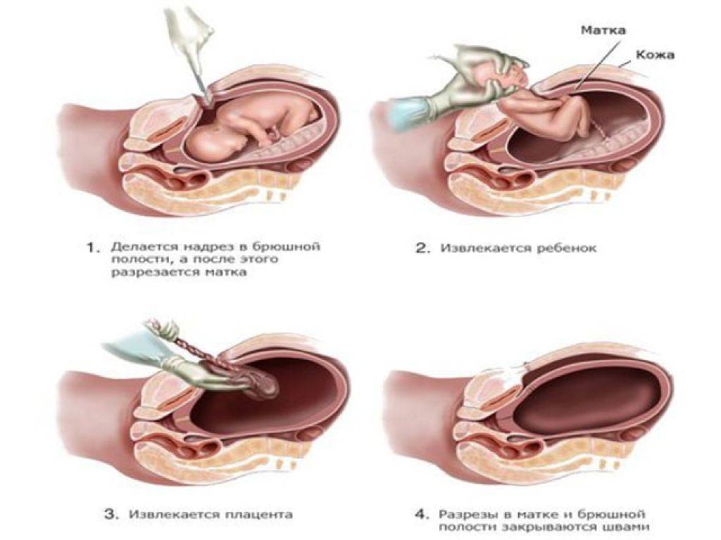 Кесарево сечение разрез. Выделения после кесарево сечение. Плод при кесарево сечении извлечение.