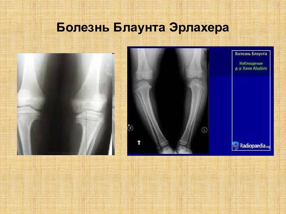 Болезнь блаунта у ребенка