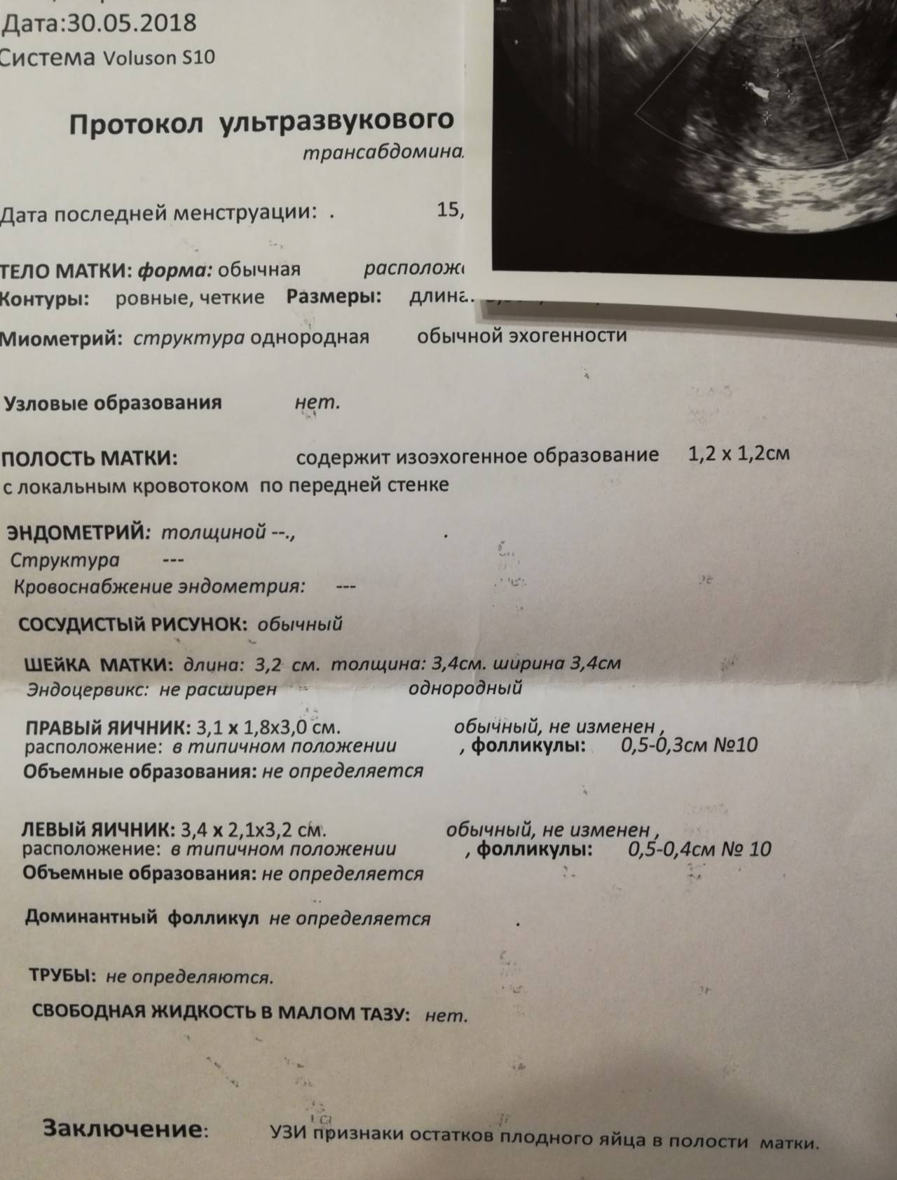 Последствия медикаментозного прерывания беременности, аборта / mama66.ru