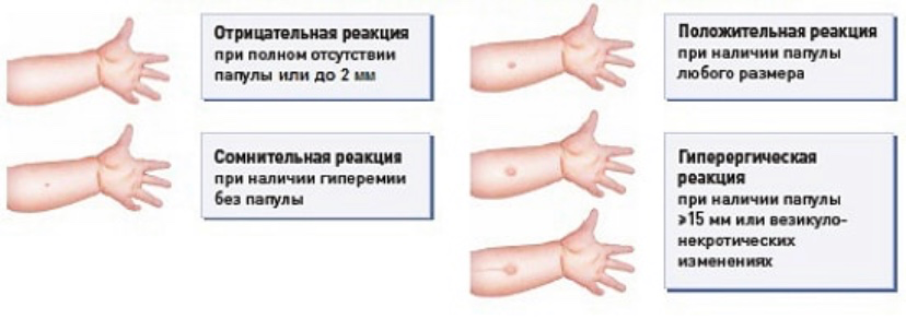 Что снимает воспаление манту