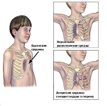 Деформация грудной клетки у ребенка – килевидная и воронкообразная: фото, лечение, массаж на видео
