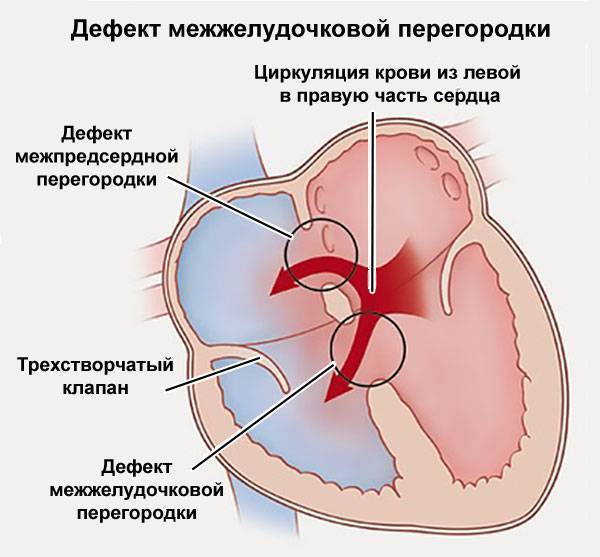 Дефект межжелудочковой перегородки сердца у новорожденных детей