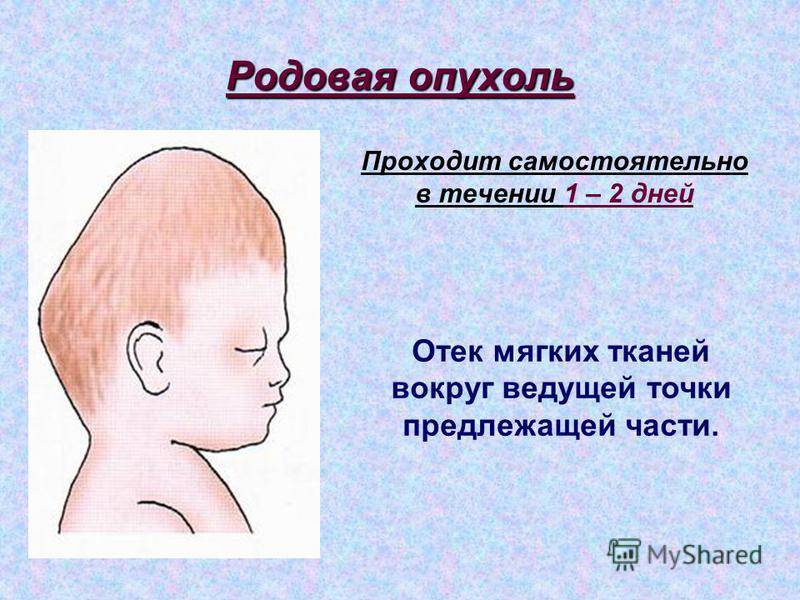 Лечение и последствия гематомы на голове у новорожденного после родов