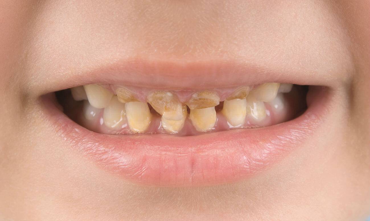 Желтый налет на зубах у ребенка: почему появляются пятна и что делать?