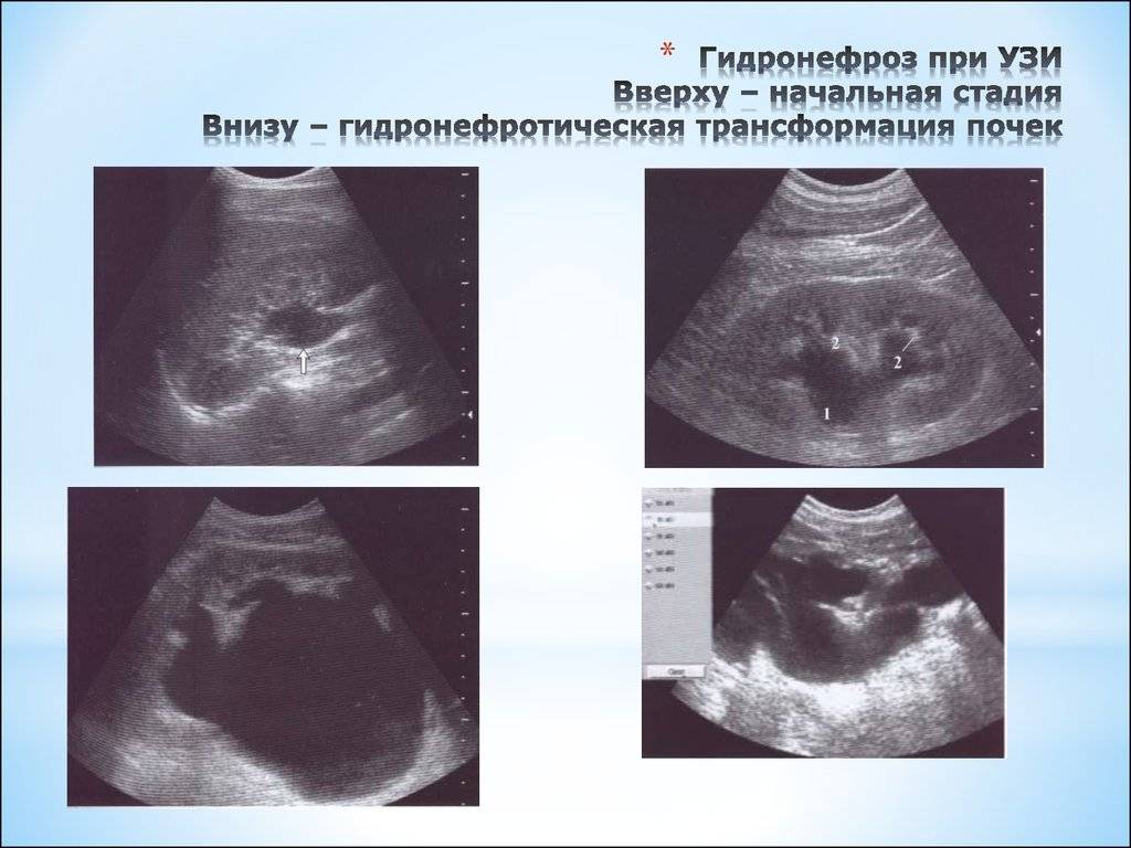 Расширенные лоханки почек у новорожденных