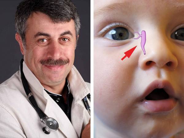Массаж слёзного канала у новорожденных: 7-ступенчатый алгоритм