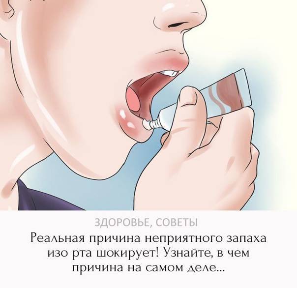 Неприятный запах изо рта у ребенка: причины, профилактика и лечение