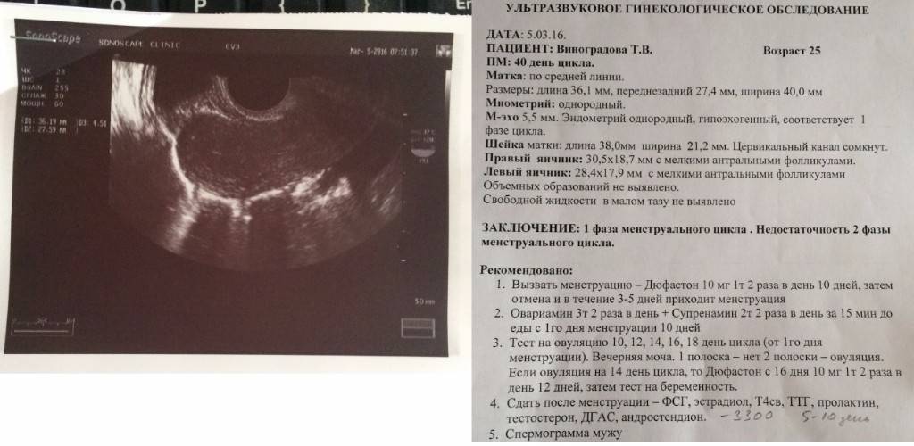 Гиперплазия эндометрия и беременность: можно ли забеременеть при этой патологии матки?