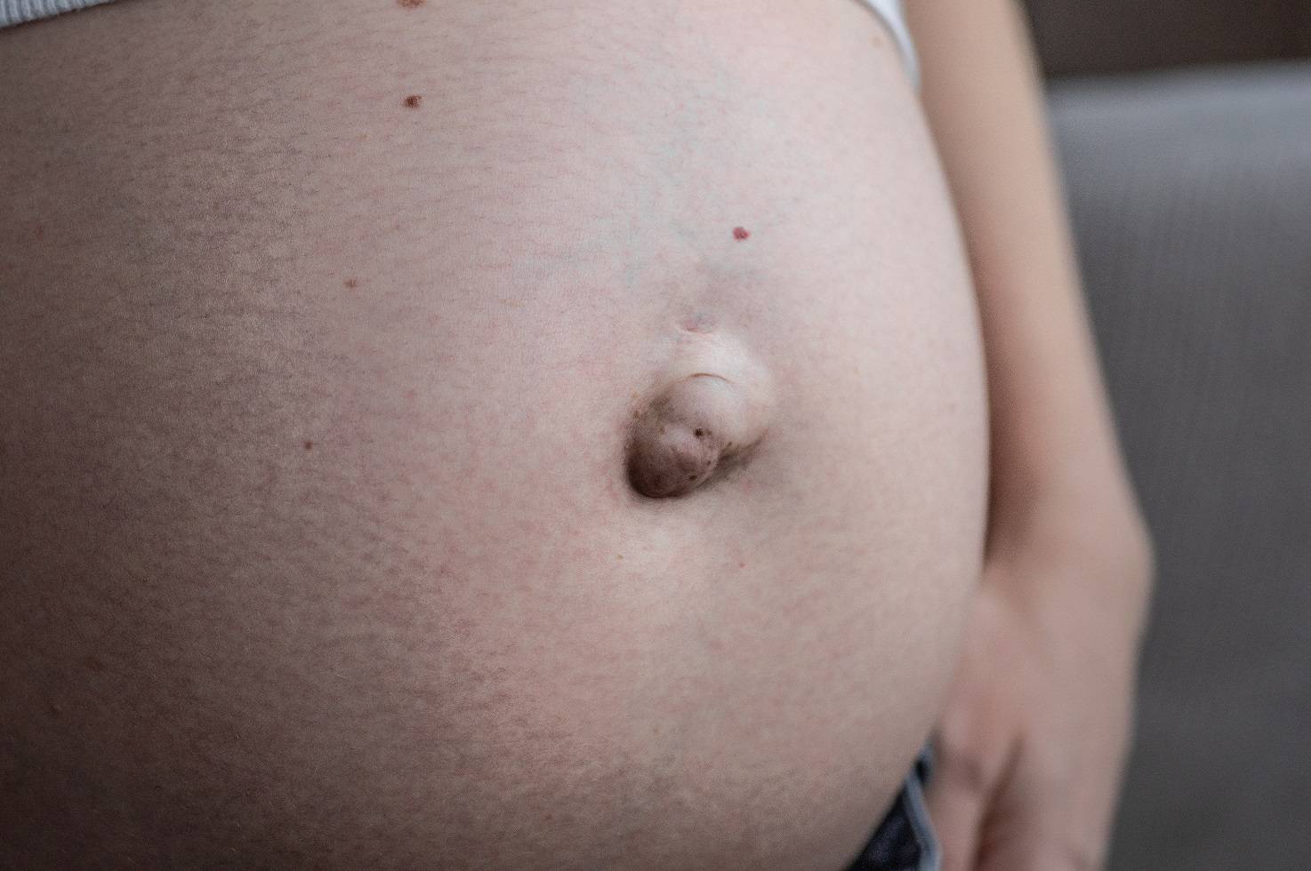 Вылезает пупок при беременности: причины и когда это происходит, что делать