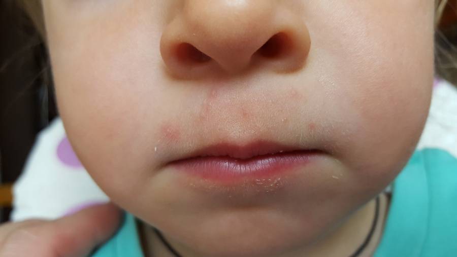 Симптомы перорального дерматита у детей на лице и эффективные способы лечения
