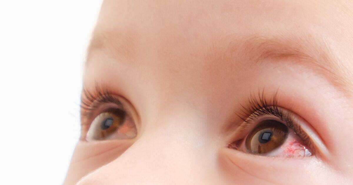 Почему у новорожденного и ребенка старше года закисают глаза: причины и лечение