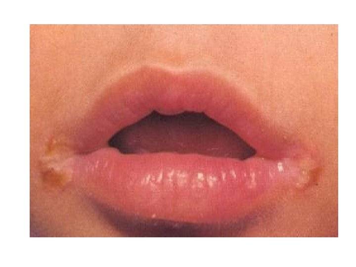 Кандидозные заеды в уголках рта и их лечение