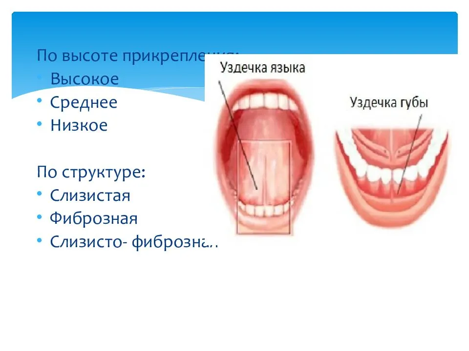 Подрезание уздечки языка: показания, методика проведения и осложнения | справочник детского стоматолога клиники семейной стоматологии «аполлония» в красноармейске