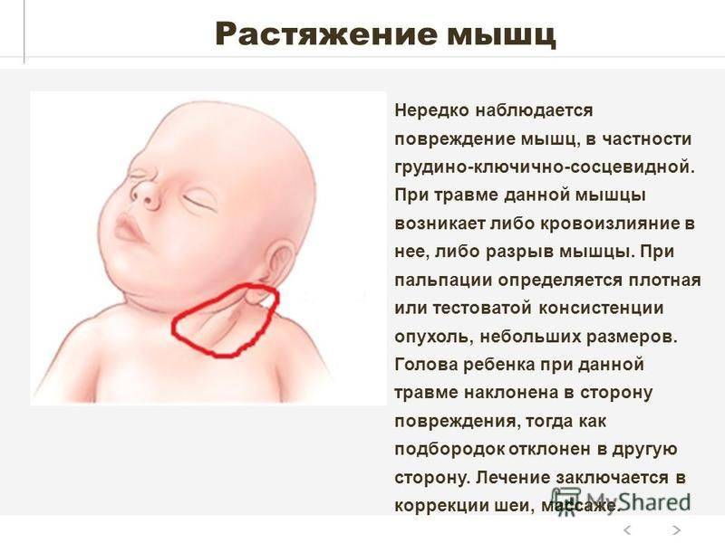Причины и последствия родовой травмы шейного отдела позвоночника у новорожденных
