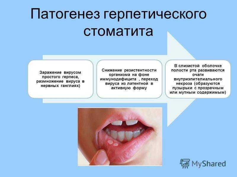 Стоматит у детей: 6 видов, признаки, симптомы, методы лечения, профилактика