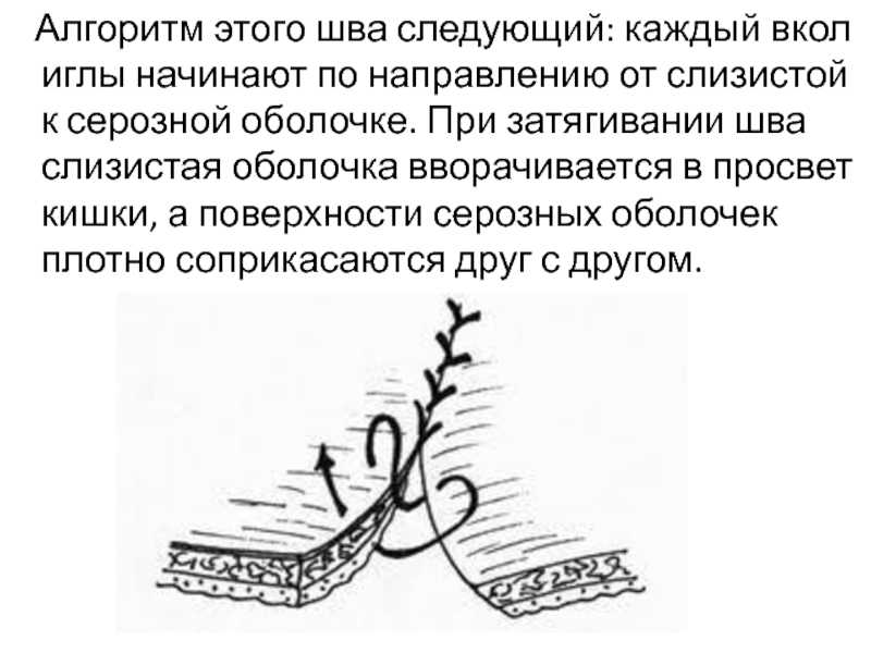 Шов после кесарева сечения: виды, уход и осложнения