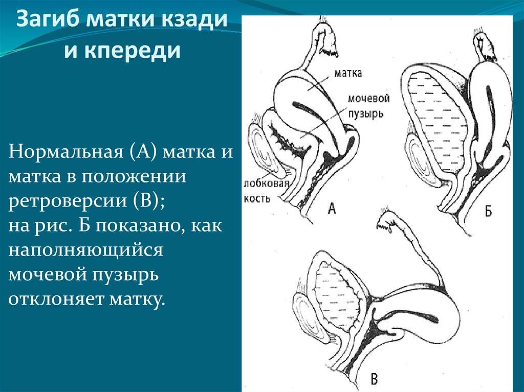 Седловидная матка при беременности — беременность. беременность по неделям.
