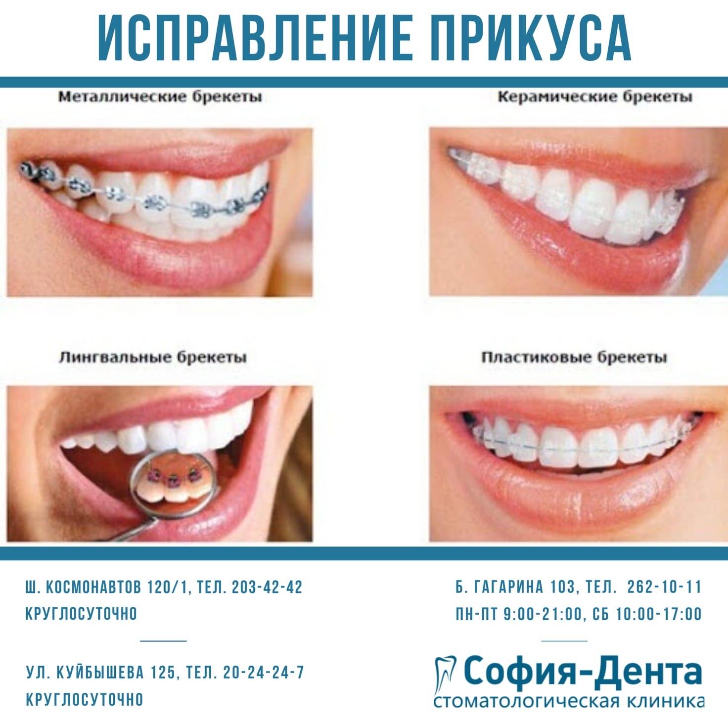 В каком возрасте можно ставить брекеты детям, сколько стоит их поставить?
