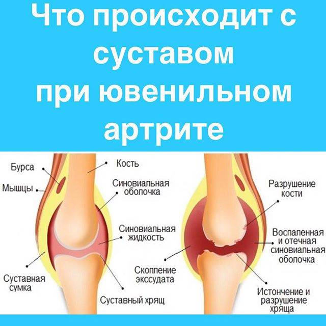 Артрит коленного сустава у ребенка: лечение и причины ювенильного детского артрита