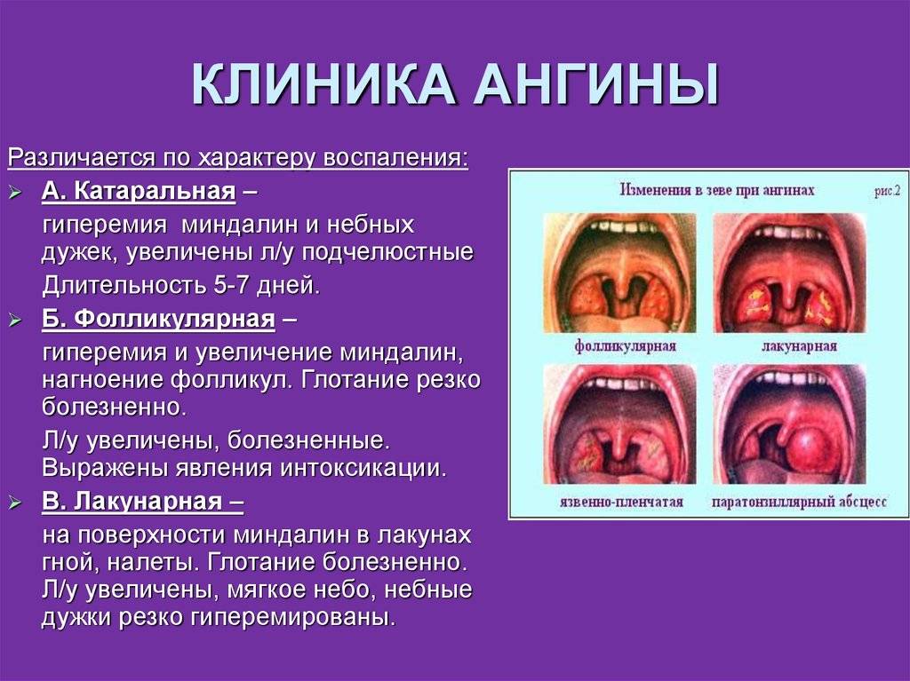 Фолликулярная ангина у детей: симптомы с фото, лечение антибиотиками