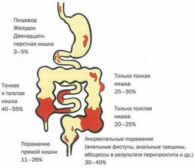 Болезнь крона у детей: симптомы, способы лечения, прогноз
