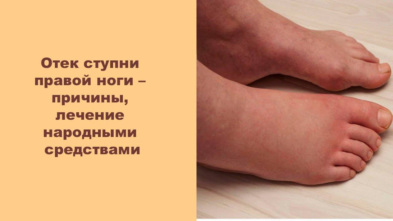 Болит пятка