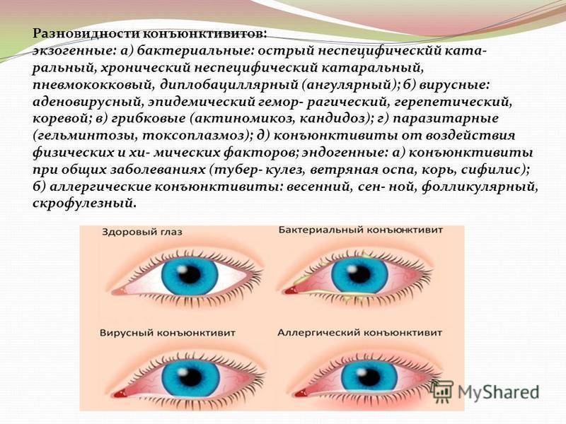 У малыша воспалились глаза: сколько дней лечится конъюнктивит у детей
