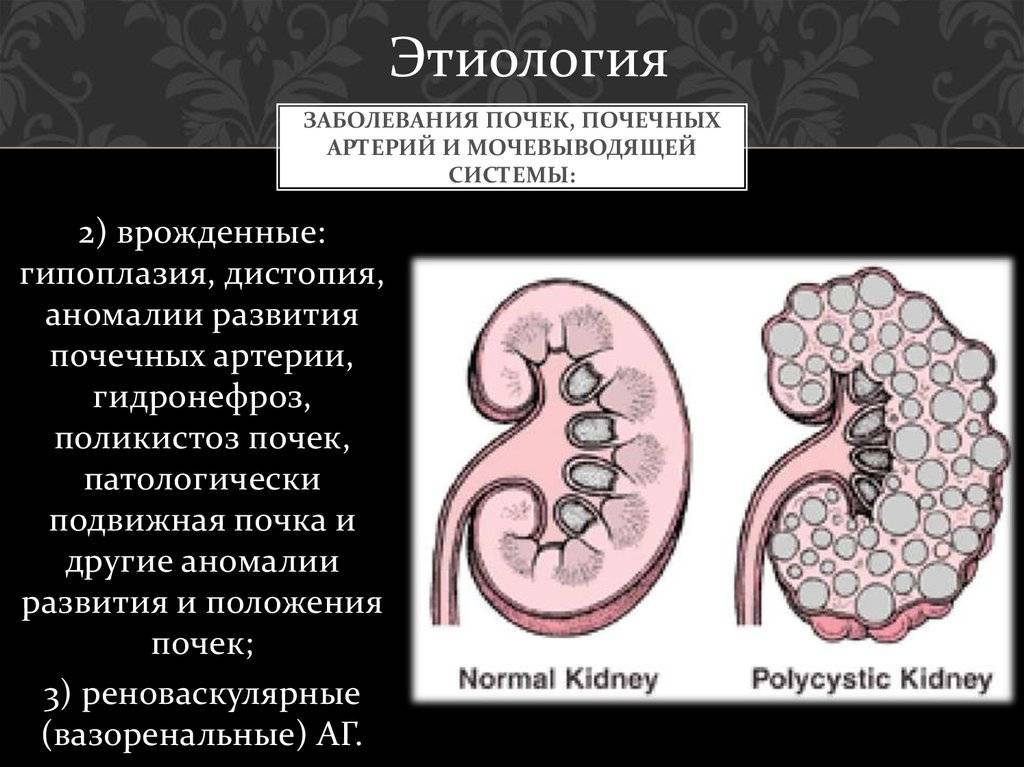 Гидронефроз у детей: причины возникновения, диагностика, лечение и профилактика заболевания