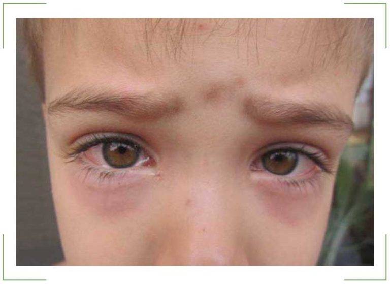 Красные круги под глазами у ребенка: причины, методы лечения