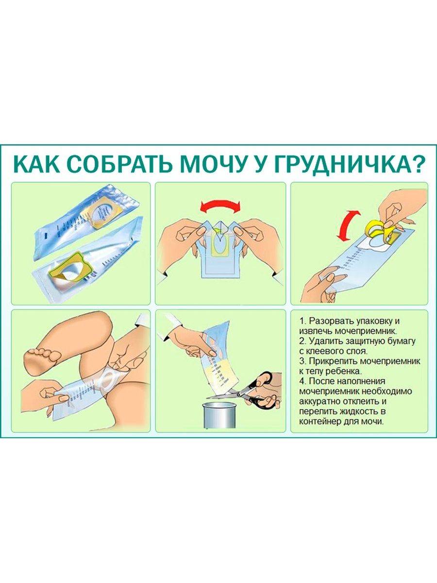 Как собрать мочу у новорожденной девочки
