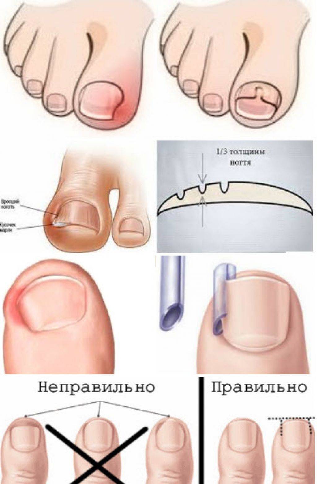 Как правильно подстричь ногти новорожденному