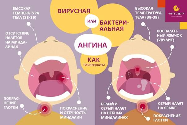 Особенности вирусной ангины: симптомы, причины возникновения, лечение