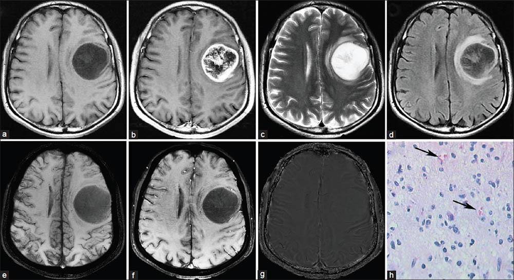 Опухоли головного мозга: признаки и симптомы на ранней и поздней стадии, причины, лечение и прогноз жизни