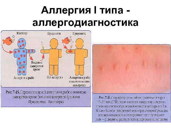 Аллергическая сыпь на теле у ребенка: виды кожных высыпаний с фото и схемами лечения