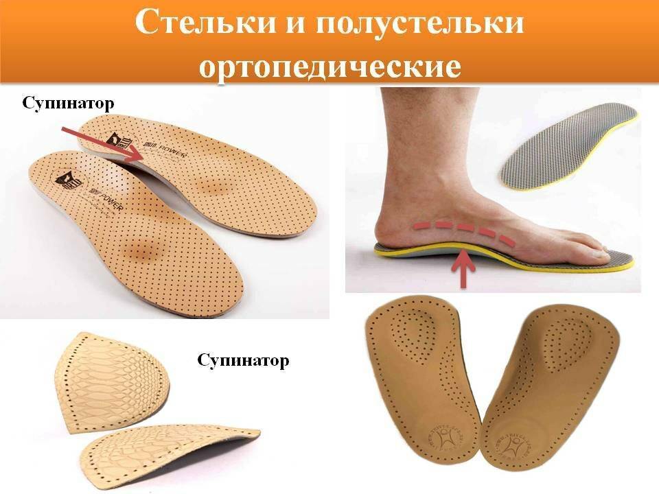 Особенности ортопедических стелек для детей при лечении вальгусной деформации стоп