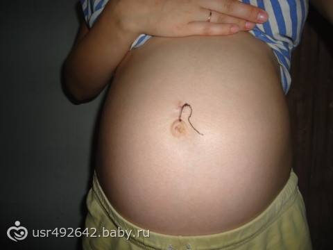 Что означает коричневый пупок у беременной женщины. почему при беременности пупок может вылезать, темнеть и становиться горячим, что делать? проблемы жкт