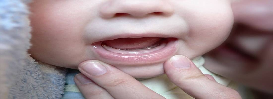 Прорезывание зубов у детей – симптомы, что нужно знать