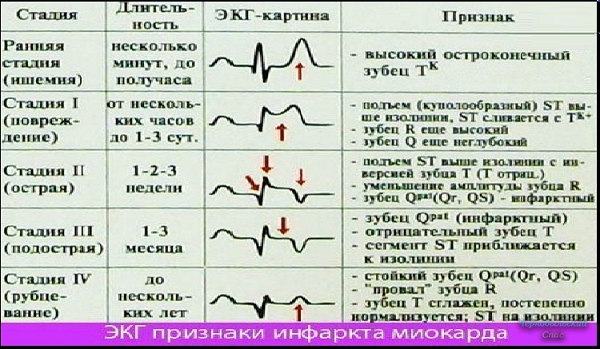 Расшифровка экг — норма и отклонения, выявление патологий