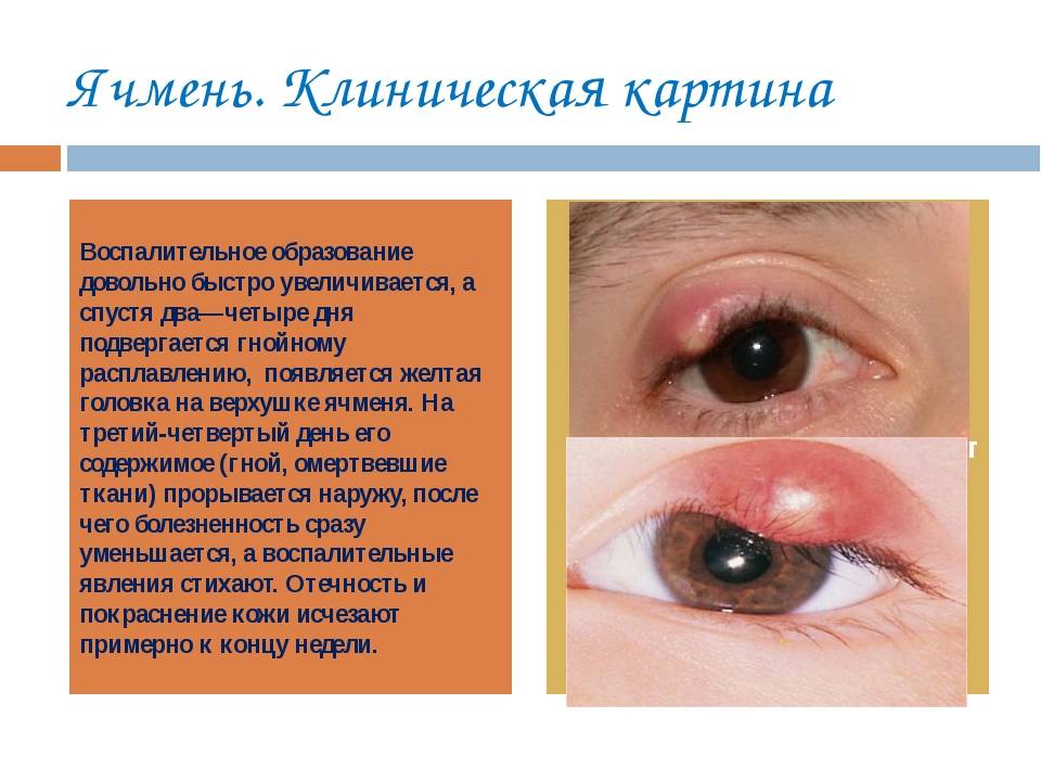 У ребёнка красные глаза без гноя: причины, фото, чем лечить органы зрения, если нет выделений, какие есть препараты для лечения