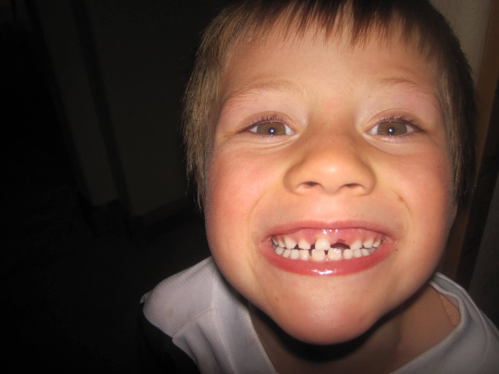 Потемнел зуб после удара у ребенка: что делать